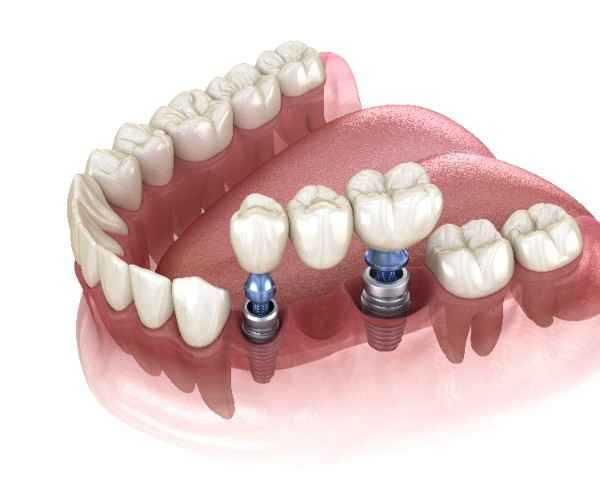 invisalign Coleraine