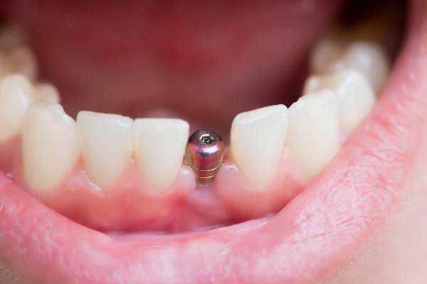 invisalign Coleraine